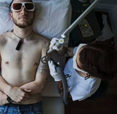 Common Misconceptions About Tattoo Removal